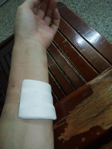 要缝起来,不然伤口无法愈合 追问: 可是医生说不缝针也能愈合,只是很