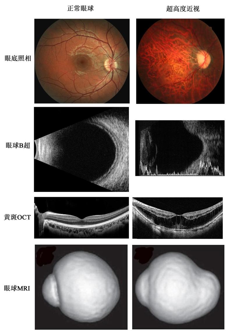 孩子只有100多度近视,医生却说是"高度近视眼"?