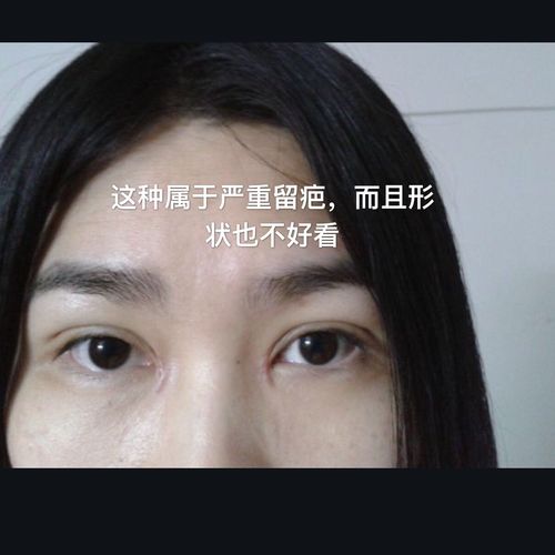 开眼角后留疤严重,两年后