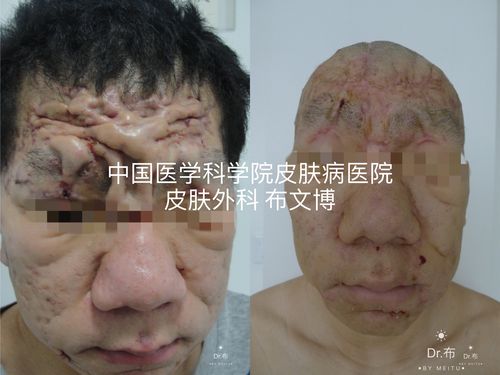 化脓性汗腺炎可以治疗,可以治愈