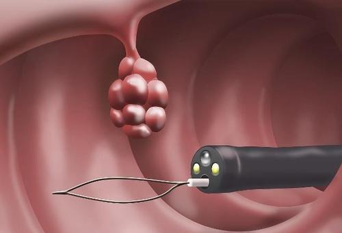 常见的"肠息肉"有5种,大部分属于良性,前2种尽量早切除