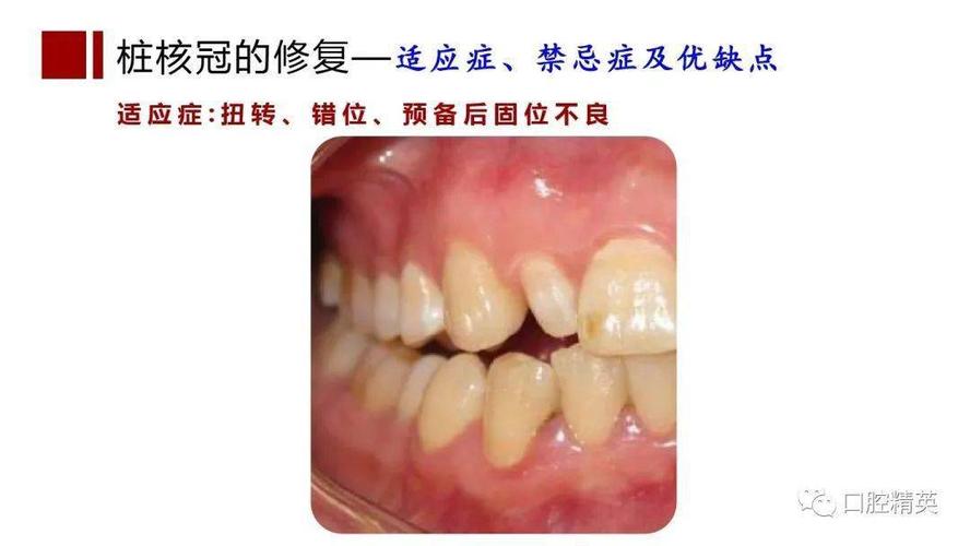 根管治疗桩核选择和桩冠修复