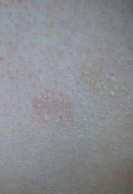 胸前长了好几个这种像癣一样,不痛不痒的