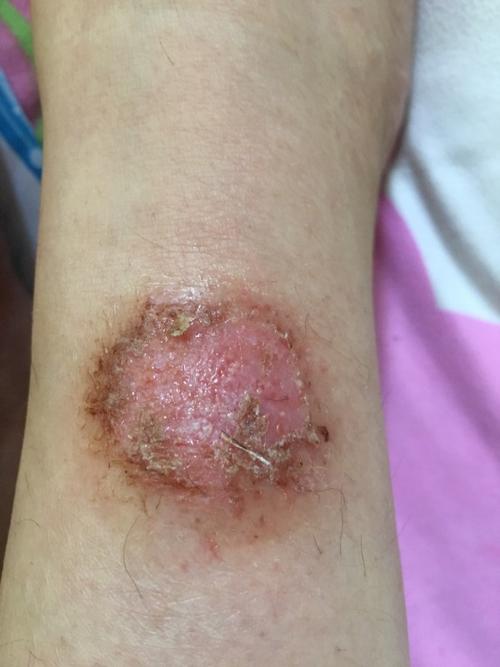 谁能帮助我看看,这是长了啥?半年了,流水,不结痂!