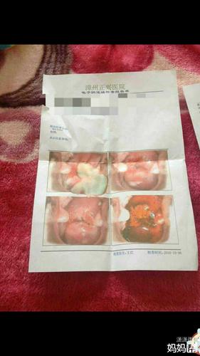 朋友宫颈糜烂2度 用药记录