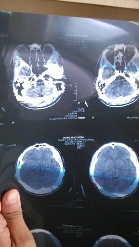 哪个大夫可以给我看看这个脑部ct的片子,我偏头痛