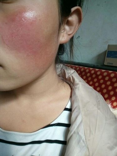 女生 脸前几天被晒伤了 总是不好 特别红 还特别