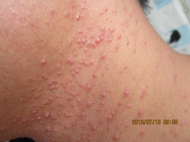 注册x  瘙痒三月,病人在某医院诊断为:湿疹,痤疮,毛囊炎,用抗生素,b6