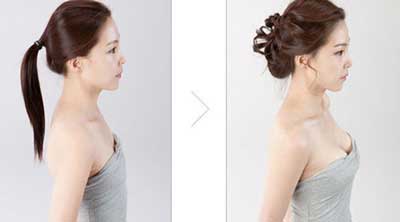 自述:平胸妹子自体脂肪丰胸