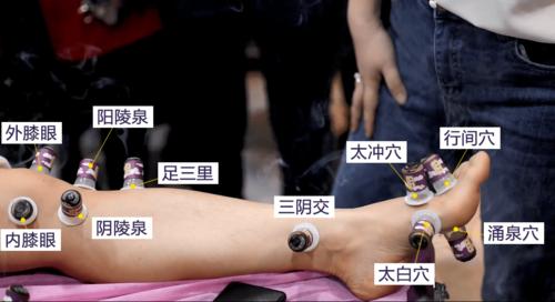 艾灸后起泡意味着什么?90%的人还傻傻不清楚