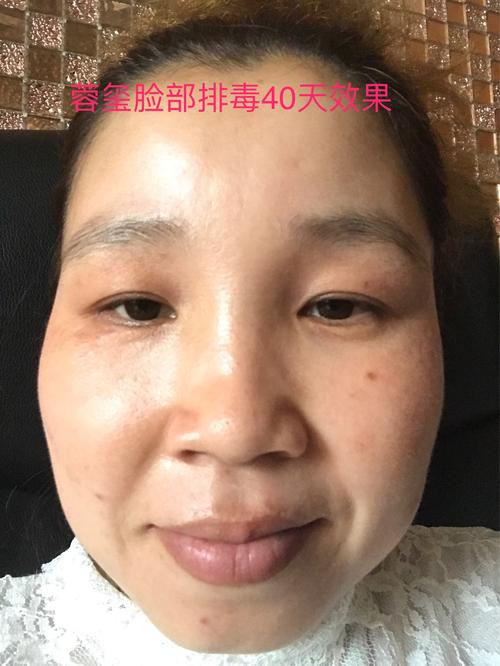 使用斑美拉容玺脸部排毒40天效果