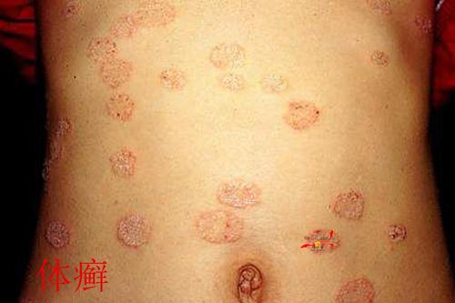 真菌性皮肤病简介