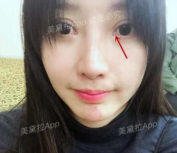 开内眼角的其中一个目的就是要增加暴露泪阜,但必须适度.