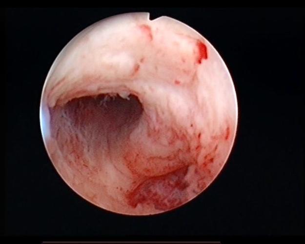 被误诊的宫腔粘连