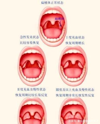 儿童扁桃体分为鼻咽扁桃体,即腺样体和腭扁桃体,我们通常称之为