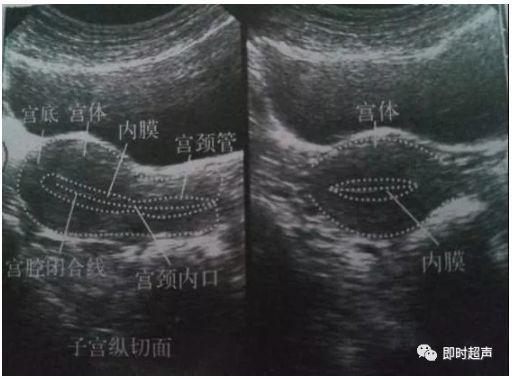 子宫纵横切面图