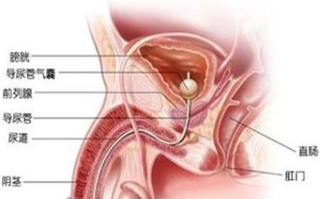 膀胱炎的症状表现是什么