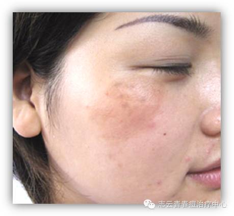 女人怎么判断自己体内有淤血,该怎么消除呢?