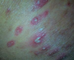 求助:屁股就开始长疮