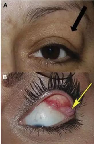 有一块很明显的凸起,用手摸的话是一个会移动的肿块,可以被推回泪腺窝