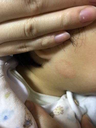 百宝脸上有一个小圆圈 开始说是湿疹 但是半个多月了
