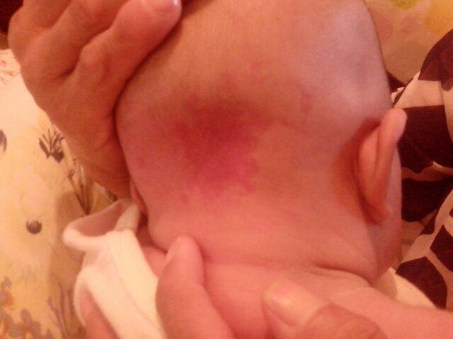 宝宝生下来身上大片红色胎记