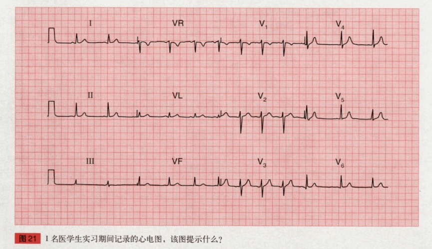 图21 心电图特点:①窦性心律;②心电轴正常;③qrs波形态正常;④ st段