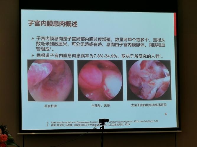 1:子宫内膜异位症诊治2:子宫内膜息肉的诊治3:子宫腺肌病的保守治疗