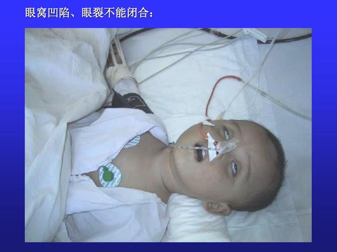 判定标准:皮肤粘膜干燥程度皮肤弹性前囟眼窝凹陷程度末梢循环(心率