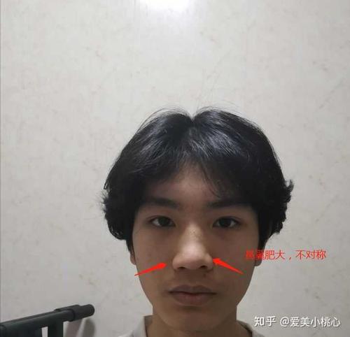 从这张图可以看出,你两侧鼻翼肥大,不对称