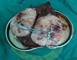 肝癌晚期为什么吃不了东西