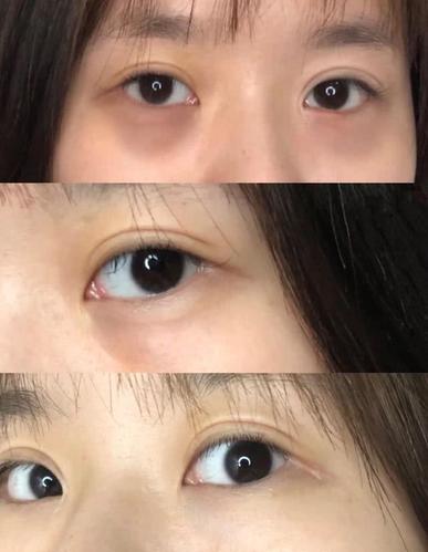 3,阴影型黑眼圈