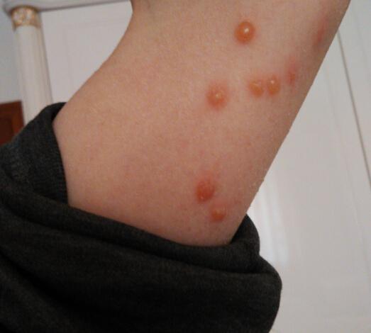 请问大神,这是带状疱疹还是水痘?