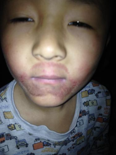 小孩子嘴巴舔的都成这样啦该用什么药请各位