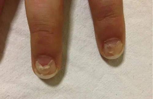 4岁男孩手指甲突然一个个脱落家长慌了竟是这病所致