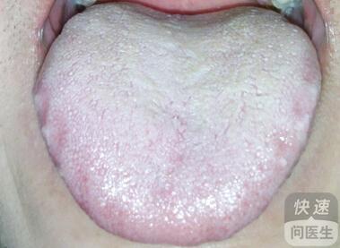 舌苔厚白燥热的原因 该如何调理