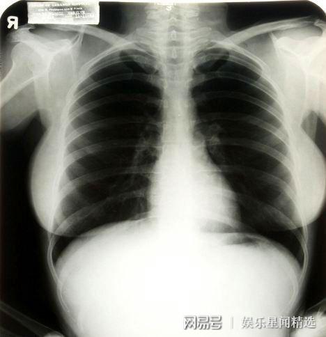 性感女神玛丽莲·梦露,那夸张的腰臀比,是手术拿掉两根肋骨吗?