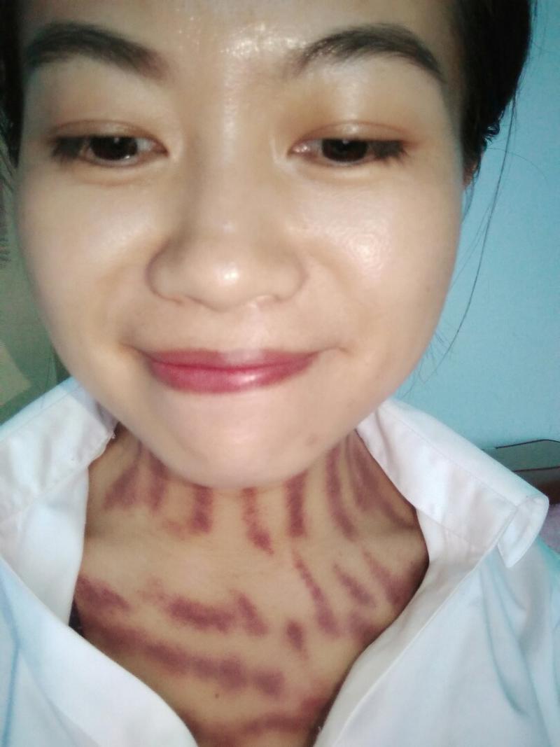 一到梅雨季节就开始出痧,揪痧的过程真是痛得死去活来