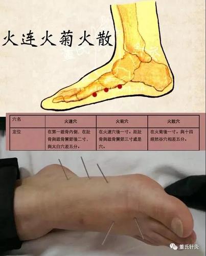 史继霞董氏奇穴针灸脚三火