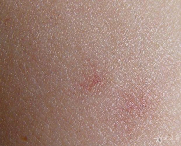 双上臂外侧色斑,蜘蛛痣?你的诊断?