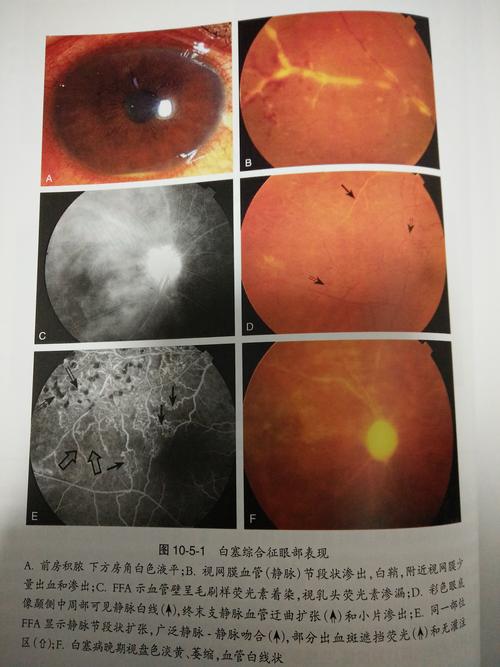 白塞氏病_疾病介绍_病因_症状_治疗