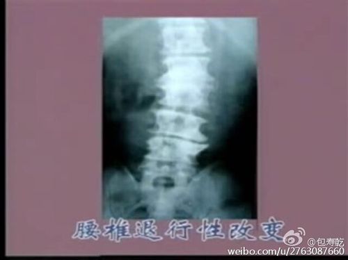 私信回复腰部脂肪疝筋膜炎及腰肌劳损的区别