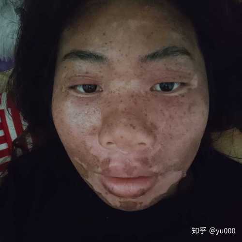 关于美容院的那种药水点痣点斑 有人说有效 有人说点了还不如以前 谁