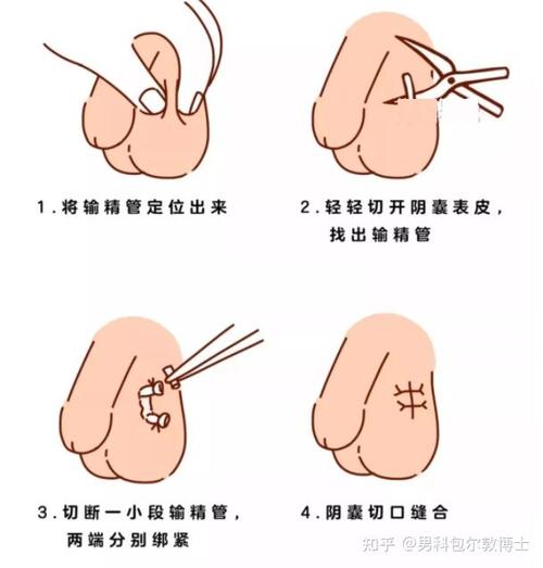 结扎这件事千万不要有什么心理压力,对于今后的生活并没有什么影响