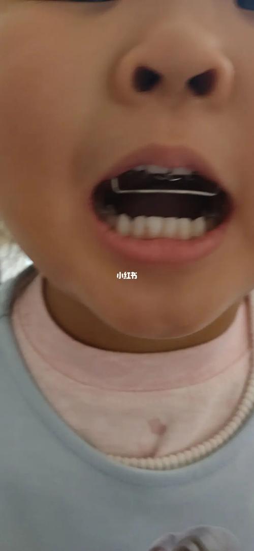 宝宝地包天【反颌】矫正完整过程_牙套_脸型_牙齿矫正_奶片_乙肝_日记