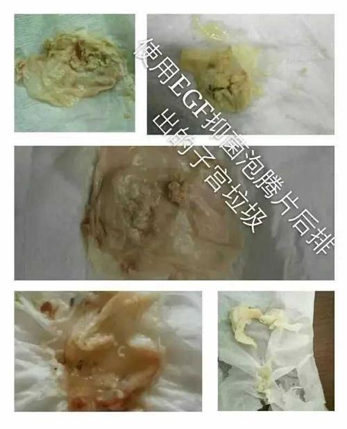 子宫里的垃圾图片大全