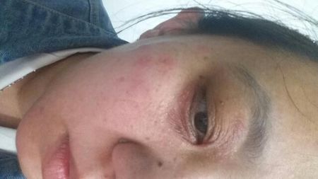 大概有半个月的时间,眼睛周围像长了红斑,而且眼睛周围有皱纹,之前都