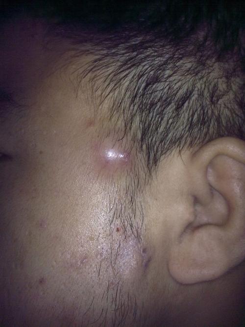 脸上脓包难以消除,该如何用药?