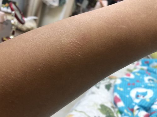 这是什么皮肤病 胳膊上一块一块鸡皮疙瘩