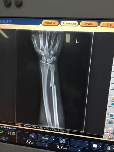 申花铁卫手臂骨折 不放弃明年再来